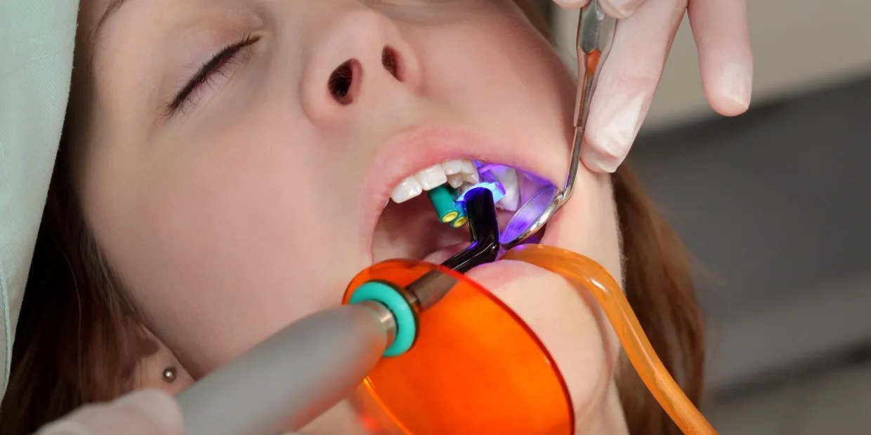 Dentist using dental UV curing light laser